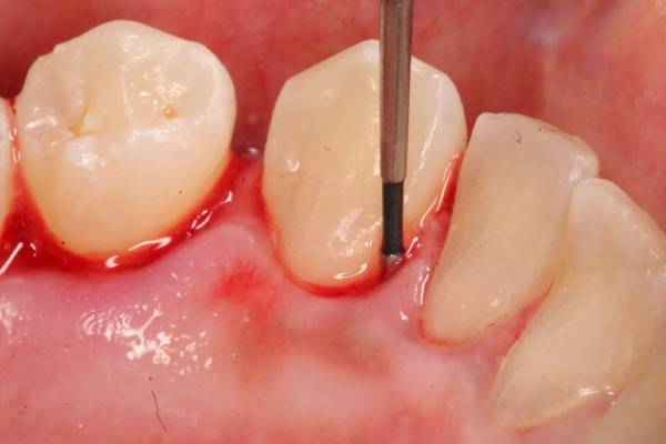 5 Reasons Bleeding Gums Mean It's Time For a visit To the Dentist -  Eastside Dental Milwaukee Wisconsin