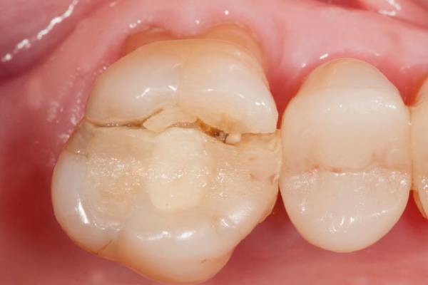 Broken or Detached Dental Crown