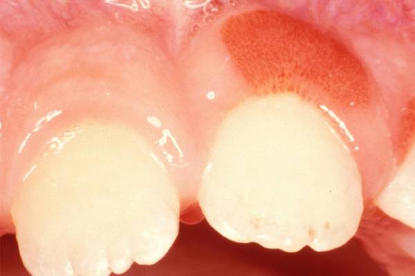 Swelling in the Gums